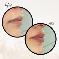 Lip-Filler Hyalurons&auml;ure