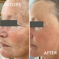 Microneedling Before and After