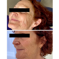 Microneedling Before and After